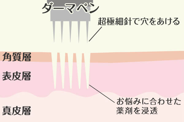 ダーマペンはどんな治療？