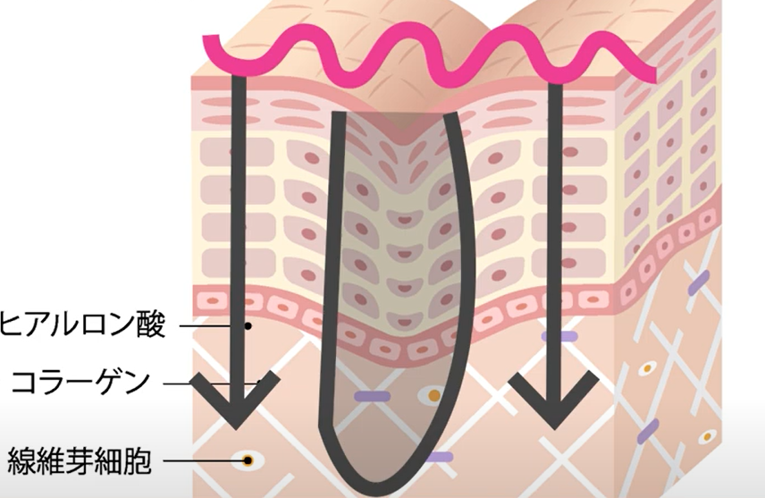 ニキビ跡や毛穴の治療方法とは？